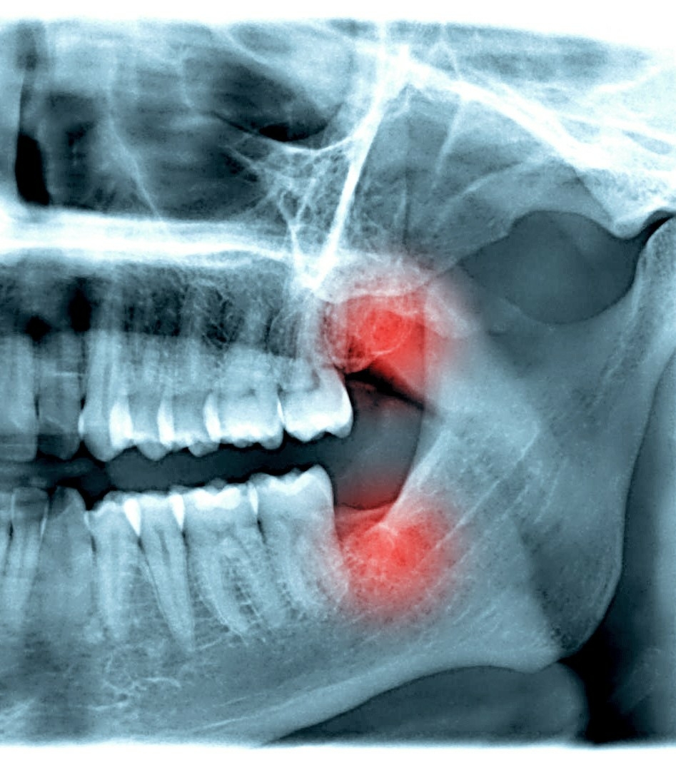 NICOs - When chronic infections silently attack the jawbone.